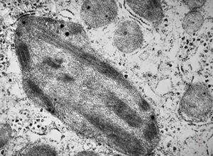M,15y. | megamitochondria with lamellar inclusions in hepatocyte - Wilson disease M,15y. | megamitochondria with lamellar inclusions in hepatocyte - Wilson disease